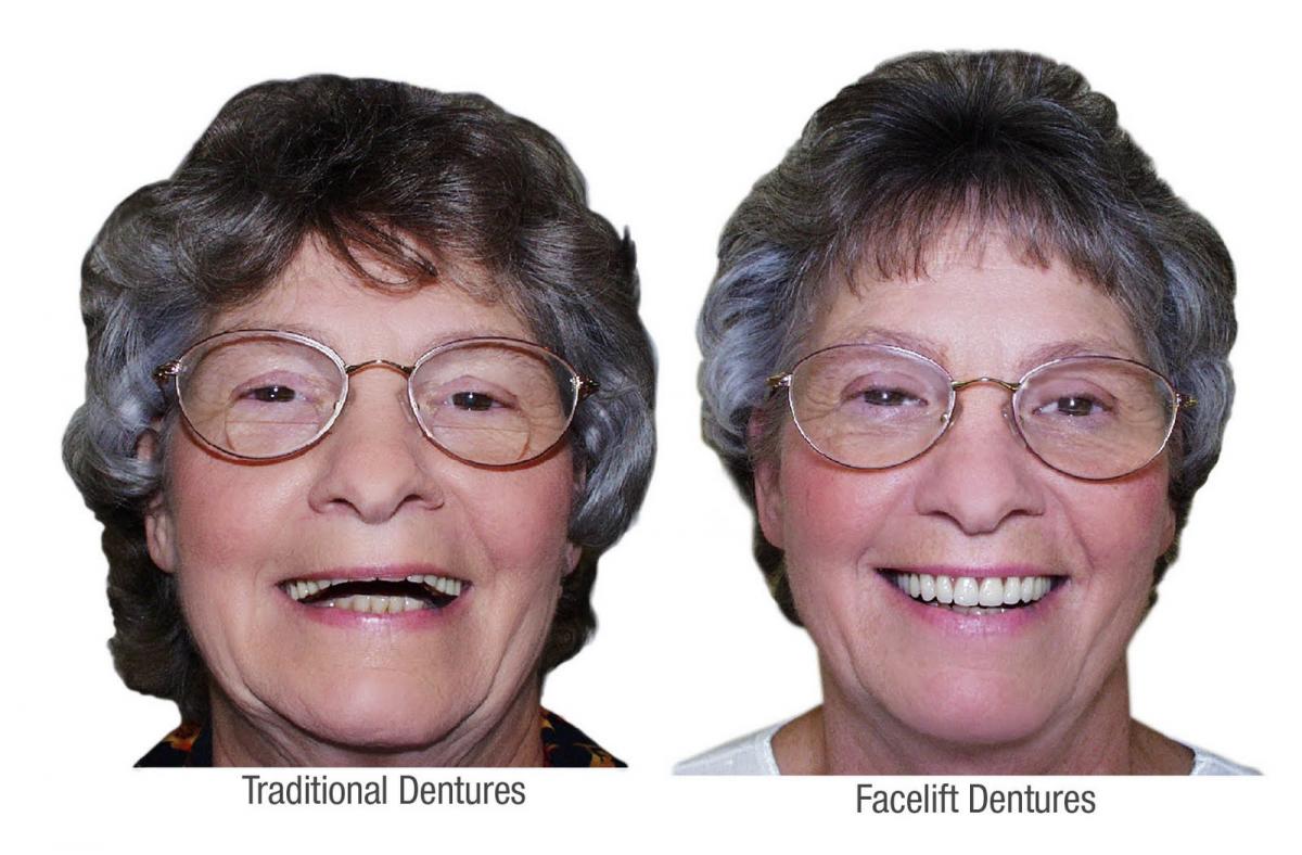 Dentures look natural 